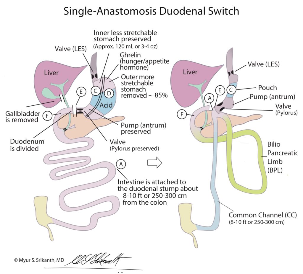 Single-Anastomosis Duodenal Switch (SIPS)
