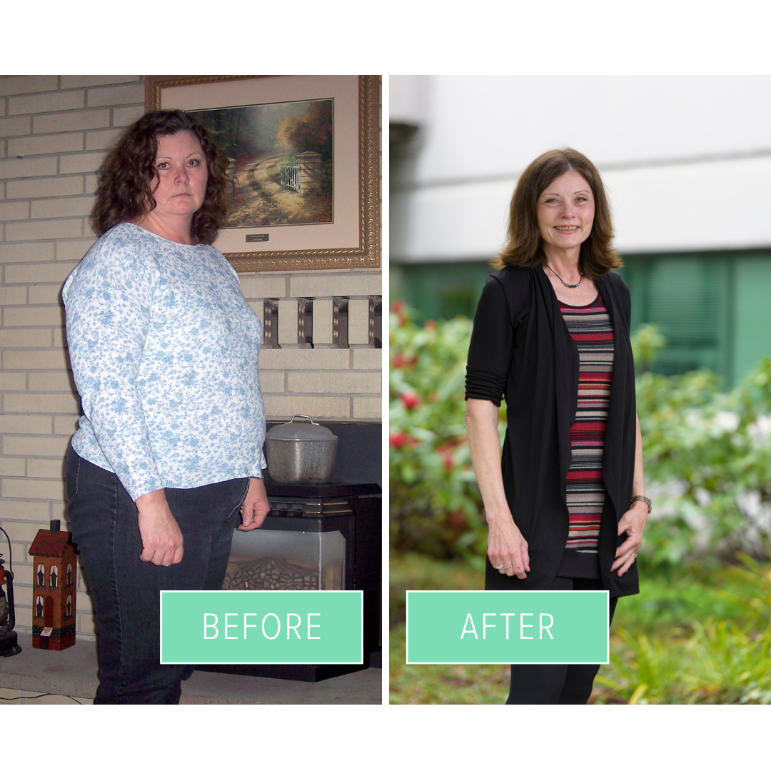 gastric bypass before and after procedure photos