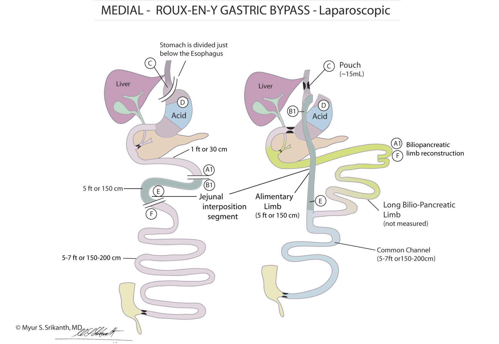 Gastric Bypass Surgery in Seattle RouxenY Bypass