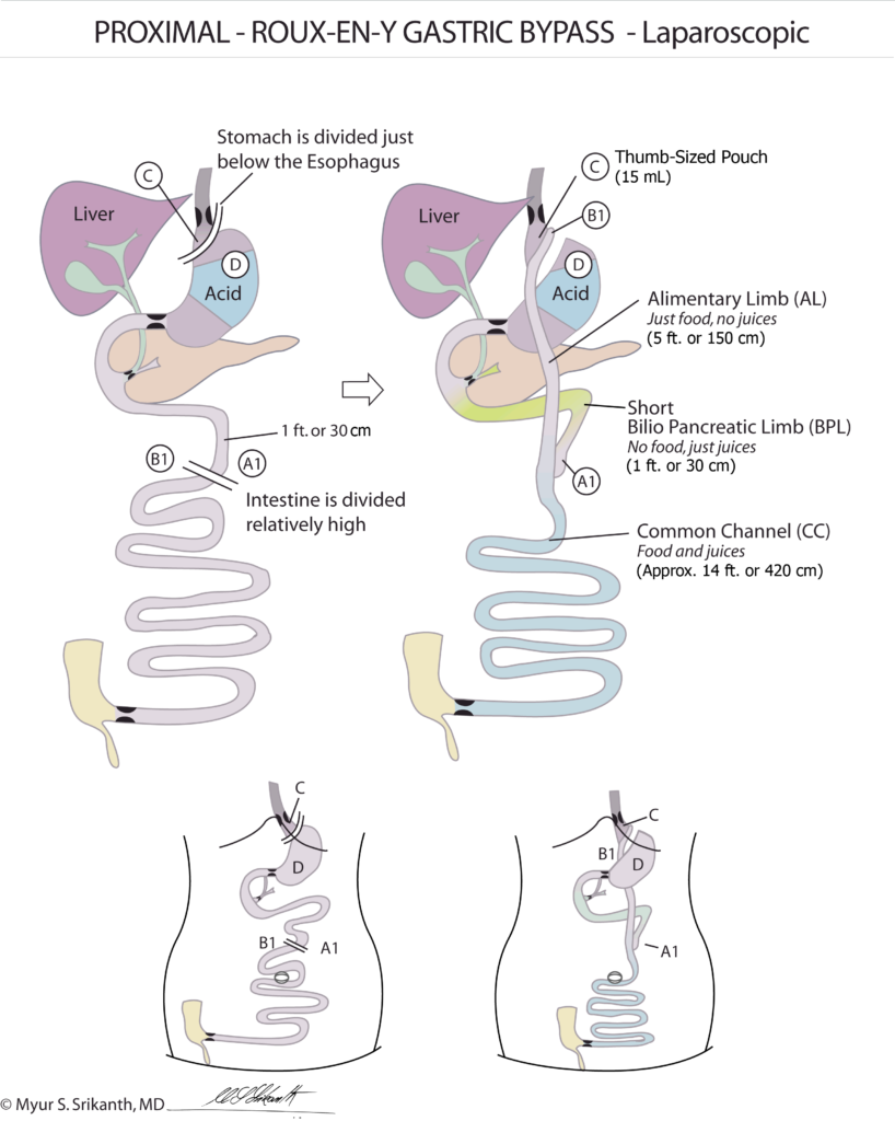 Priximal Gastric Bypass