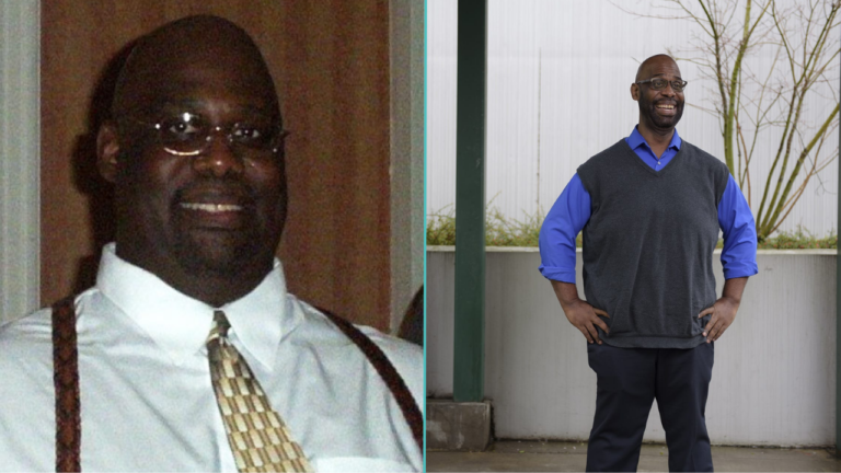 Before and after photos of someone who underwent revision from a sleeve gastrectomy to gastric bypass